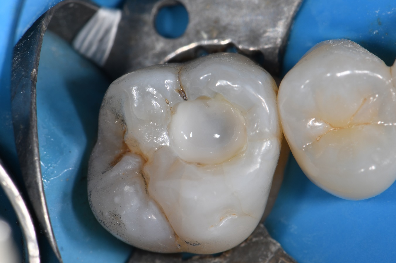 Safe Amalgam Removal and Biomimetic Restoration