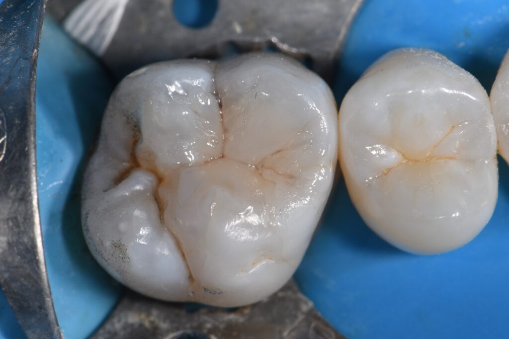 Safe Amalgam Removal and Biomimetic Restoration