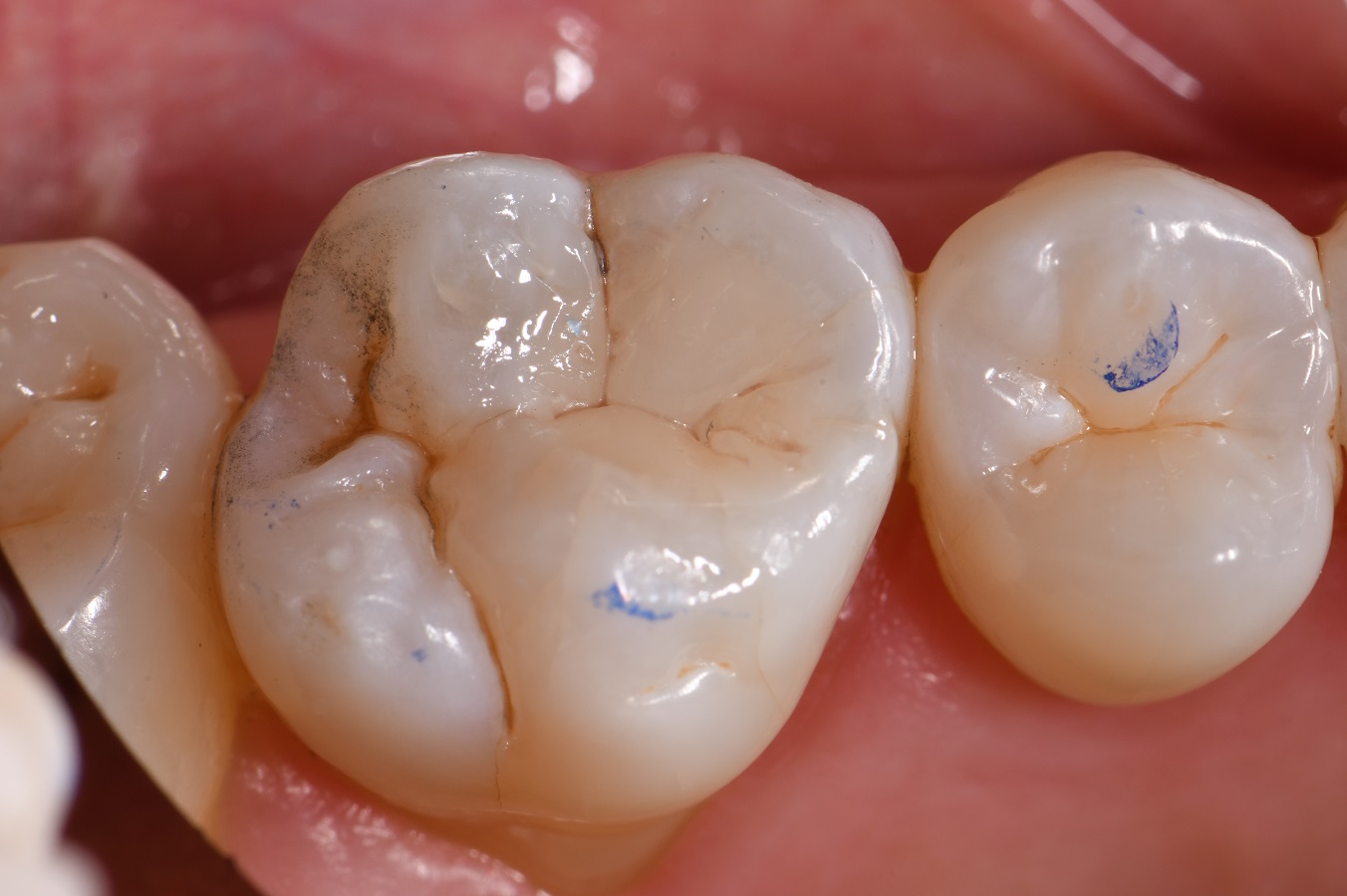 Safe Amalgam Removal and Biomimetic Restoration