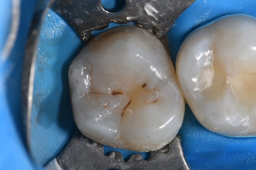 Removing Amalgams Invisibly Removing Amalgams Invisibly