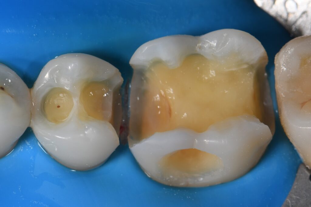 Matrix in Matrix Complex Composite Reconstruction