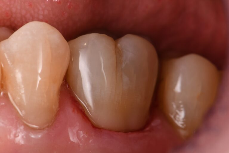 Subgingival clefts and food traps