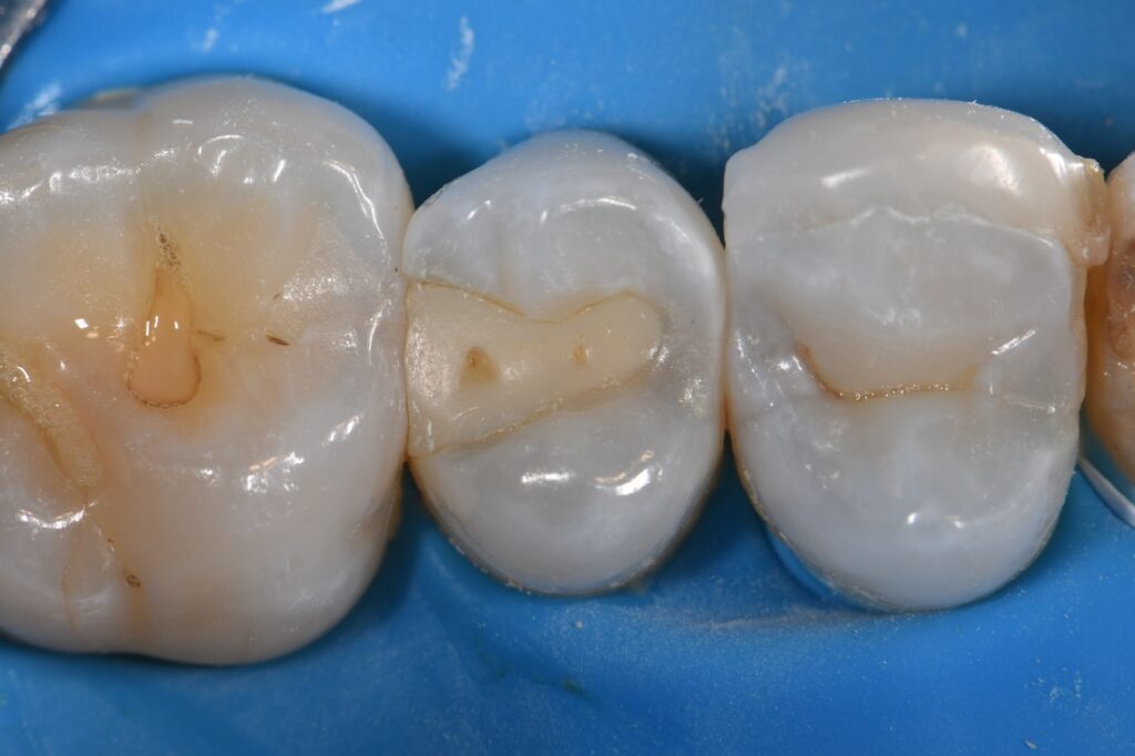 Making Dental Composites Disappear Making Dental Composites Disappear