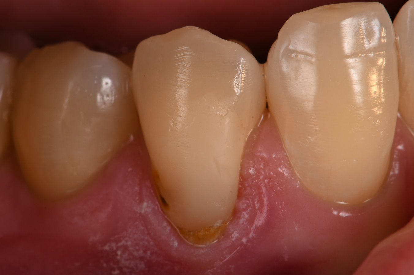 GC Class V composite restoration