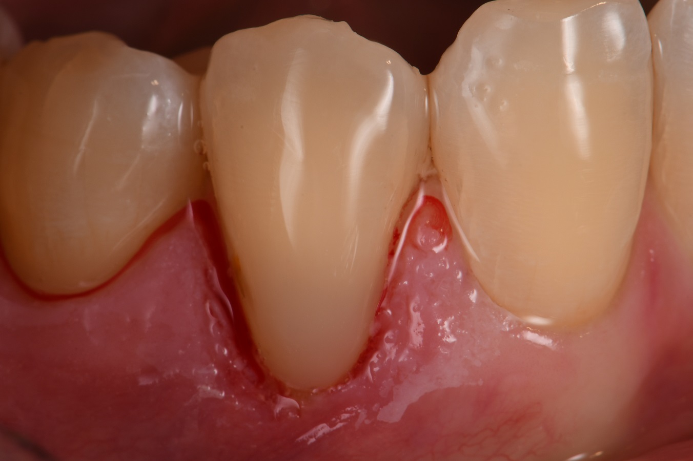 GC Class V composite restoration