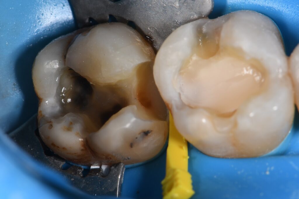 Cracks are conduits for bacteria to enter teeth