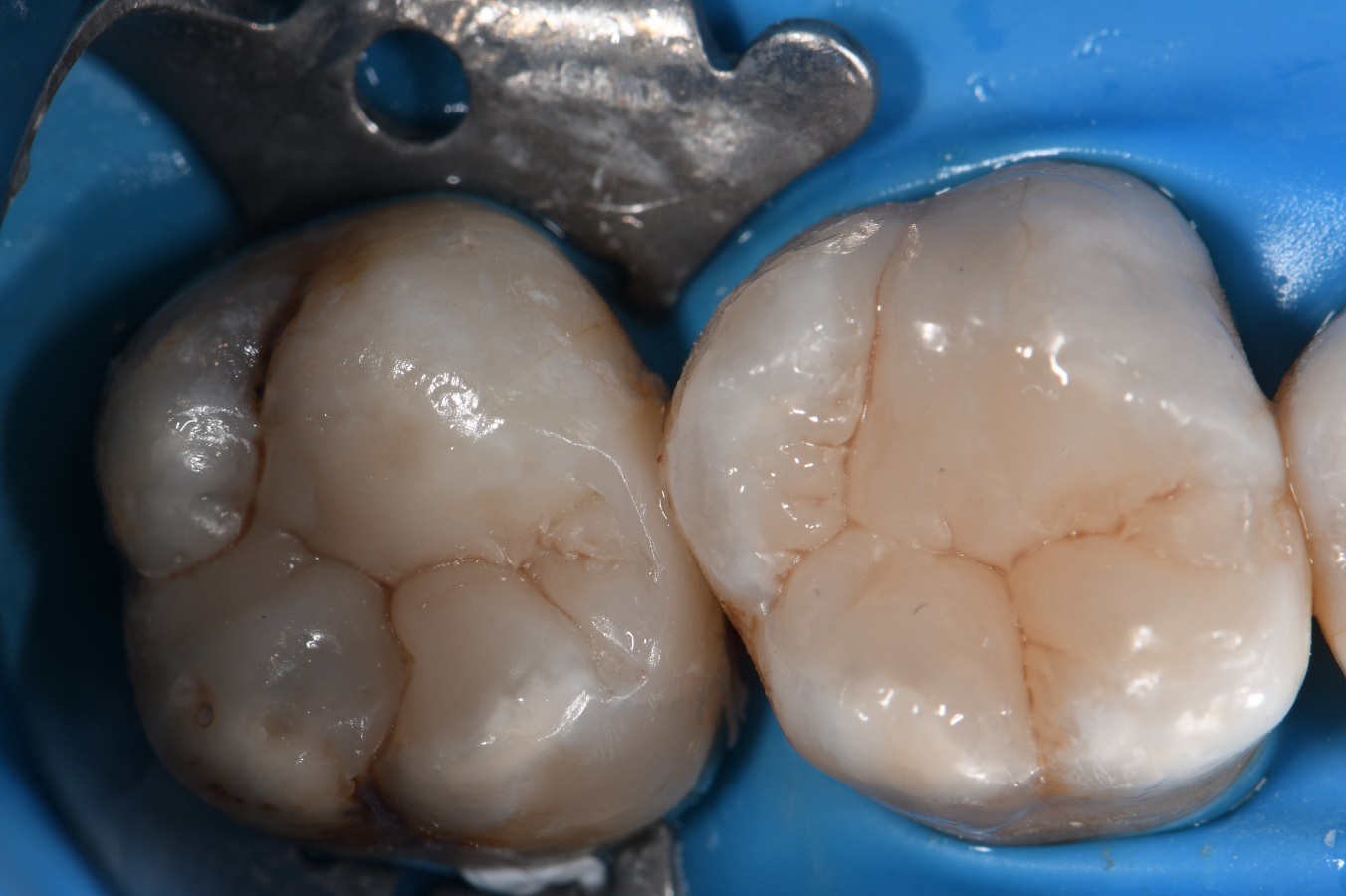Cracks are conduits for bacteria to enter teeth
