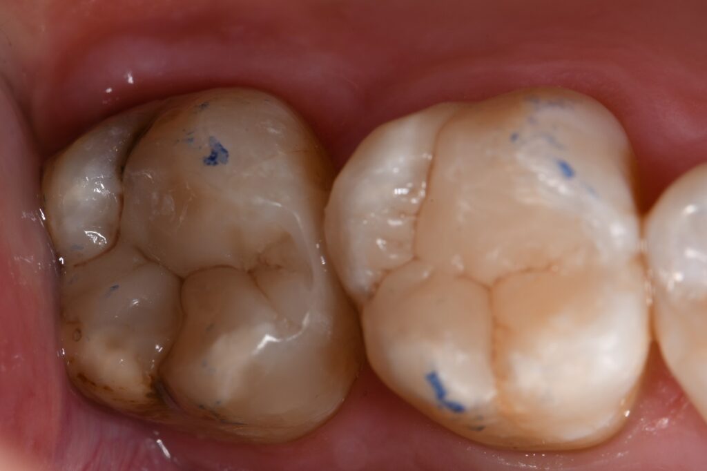 Cracks are conduits for bacteria to enter teeth