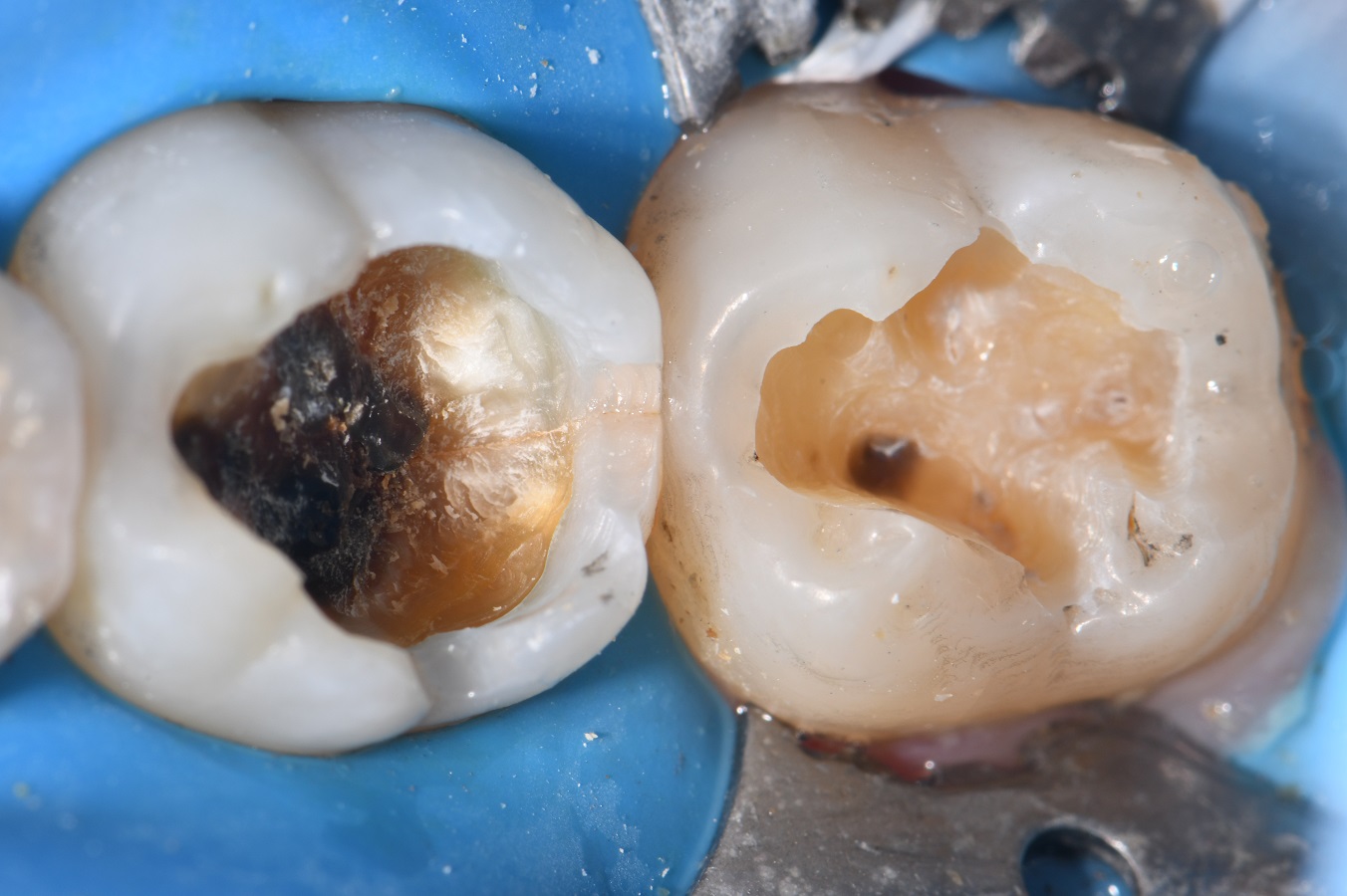 Chasing Hairline Fractures in Molars