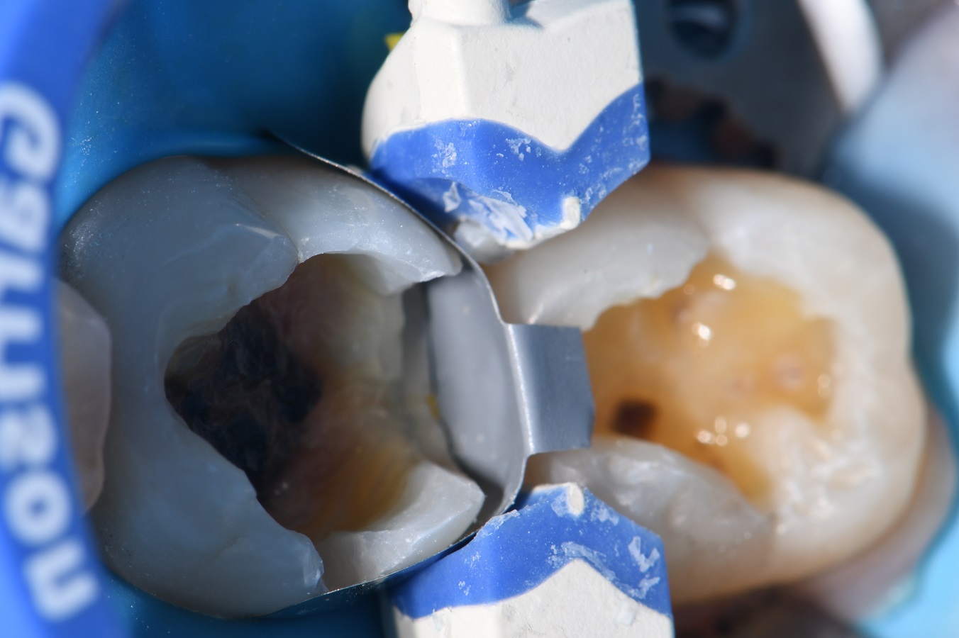 Chasing Hairline Fractures in Molars