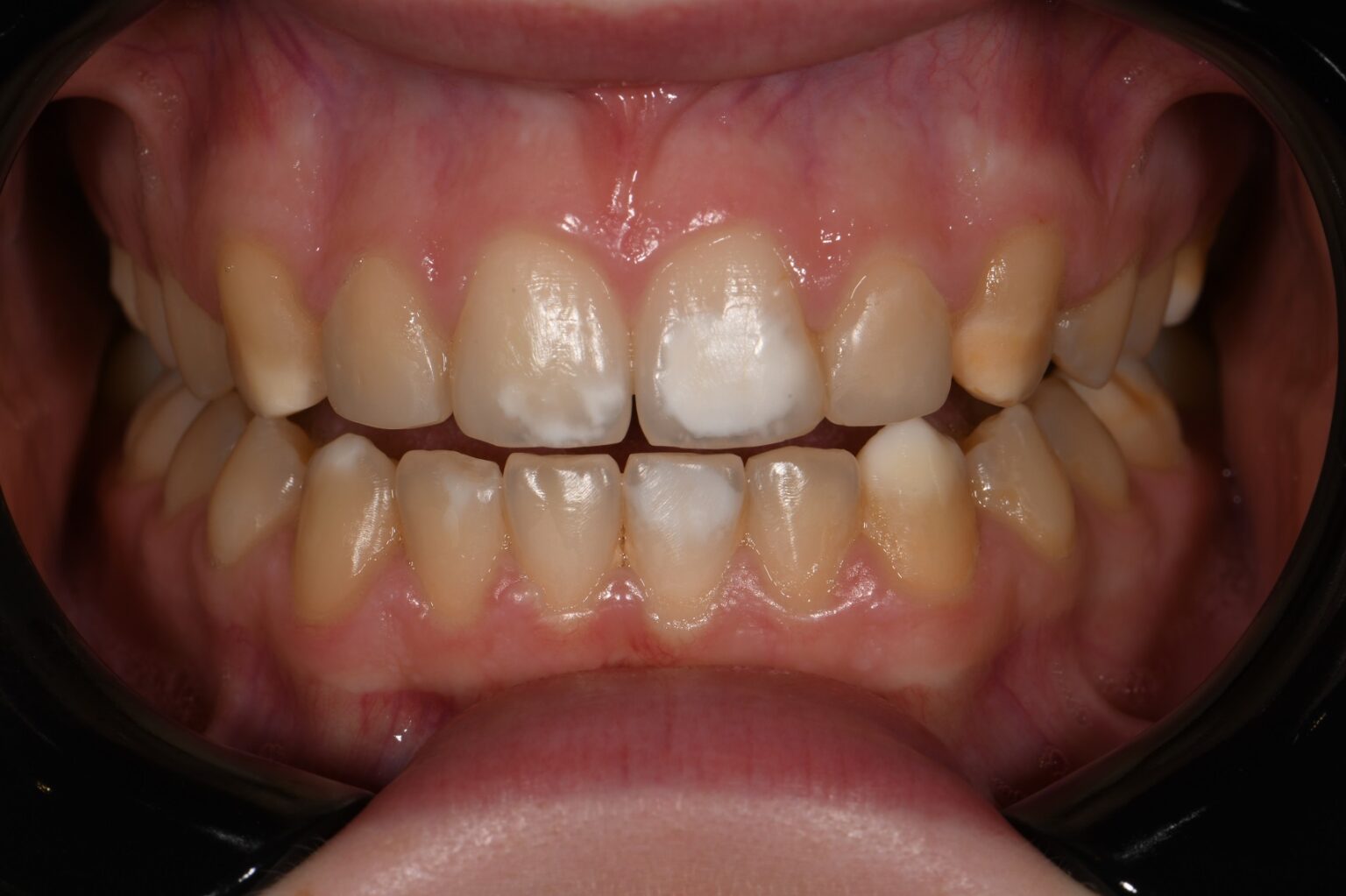 Resin Infiltration Minimally Invasive Dentistry