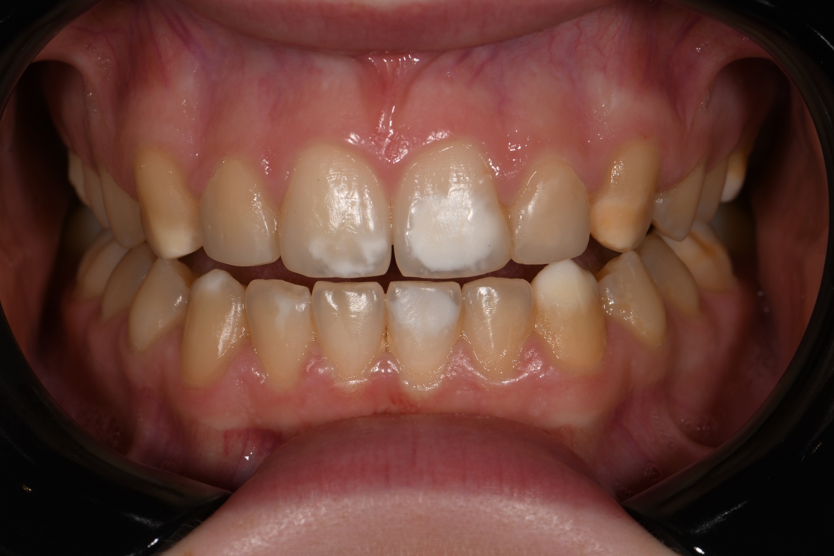 Resin Infiltration Minimally Invasive Dentistry