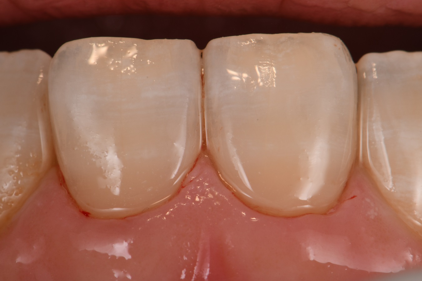 Cervical Abrasion can be aggravated by erosion