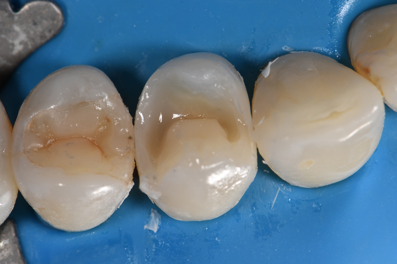Restoring Large Dental Caries