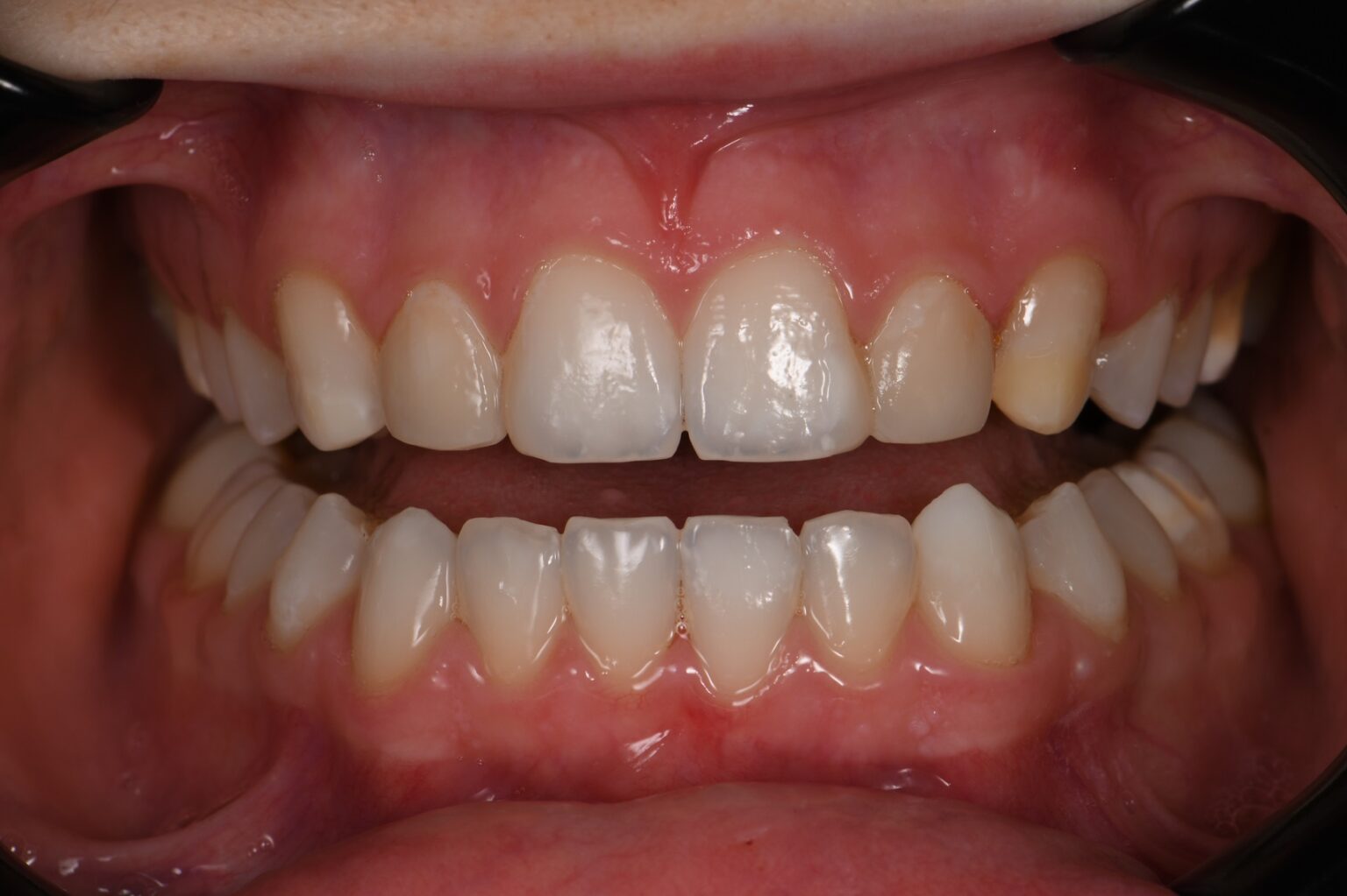 Resin Infiltration Minimally Invasive Dentistry