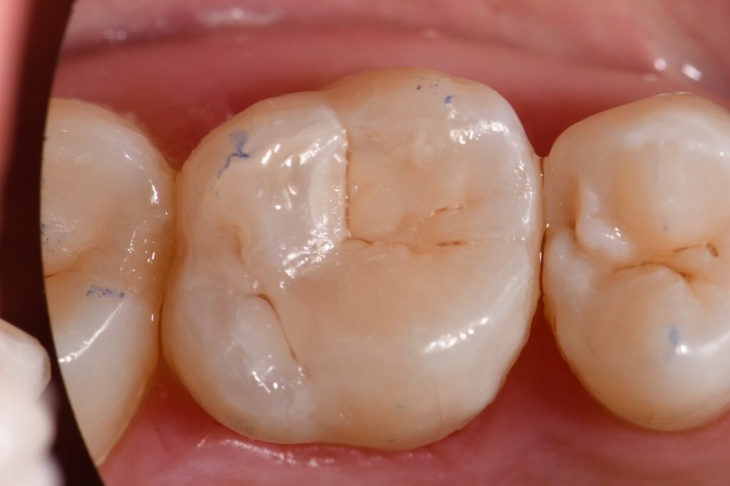 Kerr Simplishade Class I composite