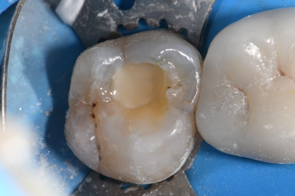 Deep Amalgam Restorations EverX Flow