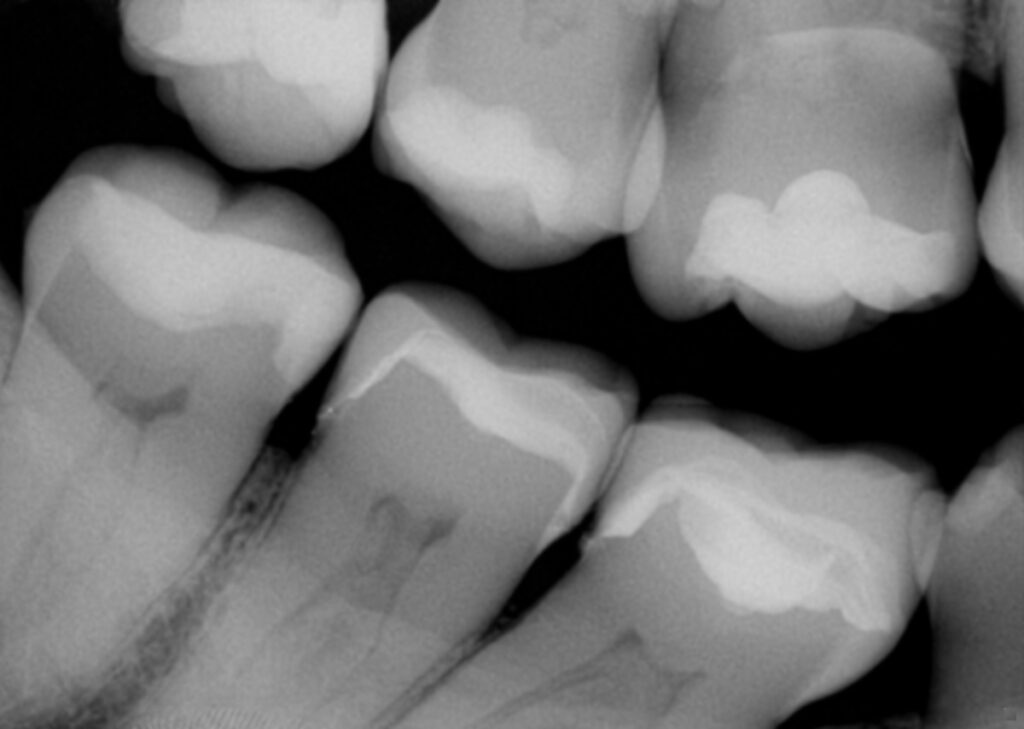 Vertical Hairline Fractures on an amalgam filled wisdom tooth