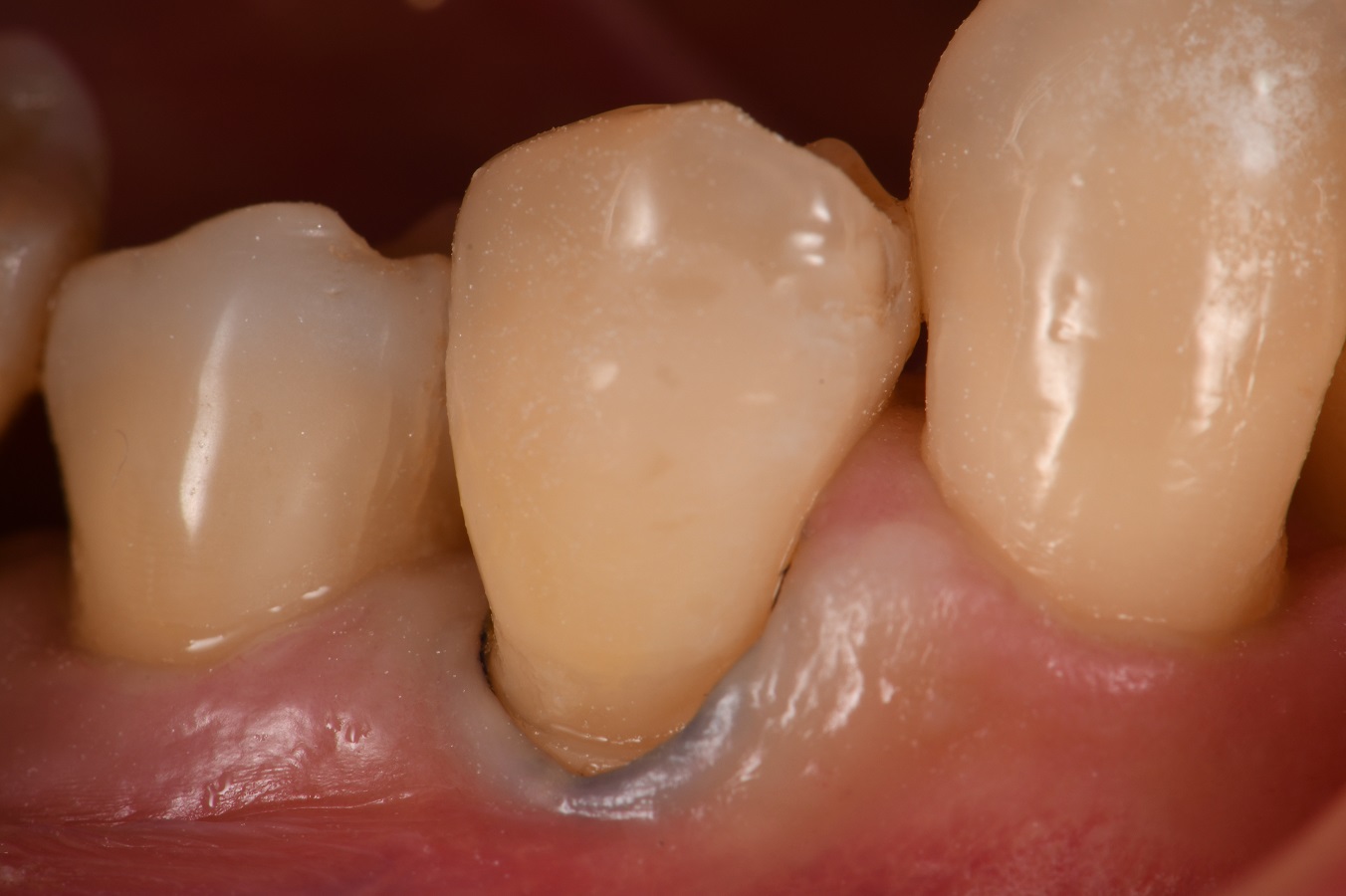 Kuraray Majesty ES2 Classic Class V restorations