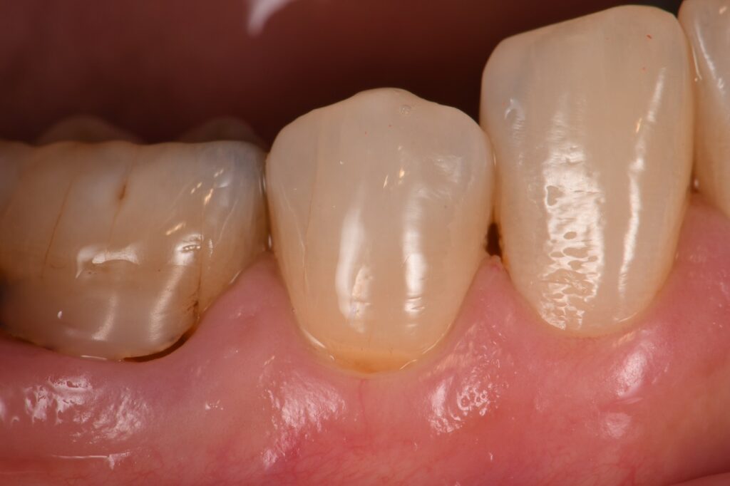 Exposed dentin restored to full form with composite
