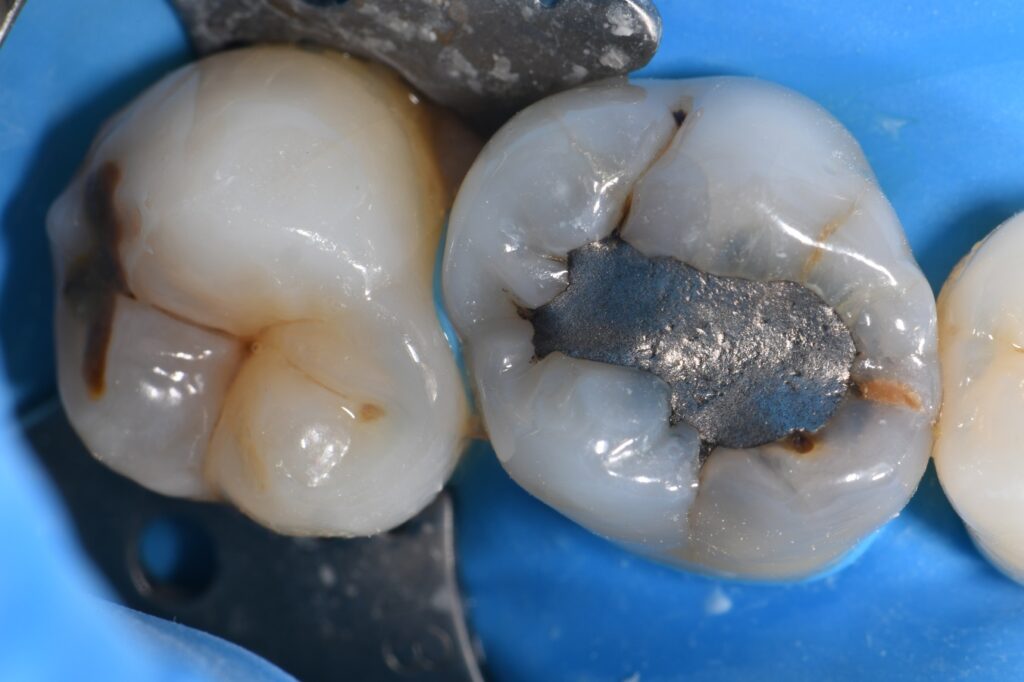 Thermal Cycling and Dental Crack Formation