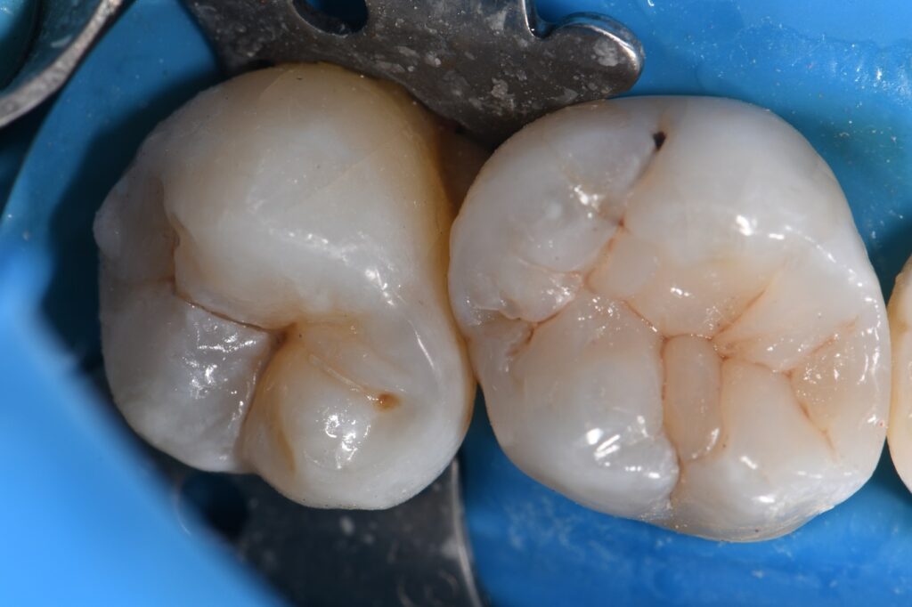 Thermal Cycling and Dental Crack Formation
