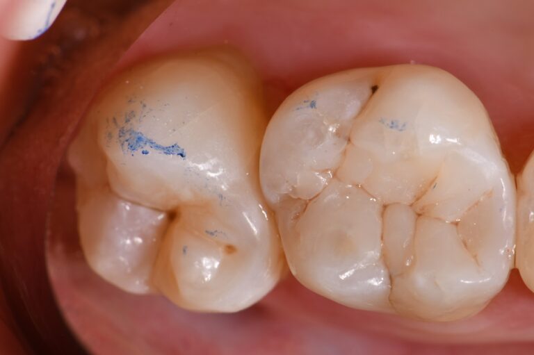 Thermal Cycling and Dental Crack Formation