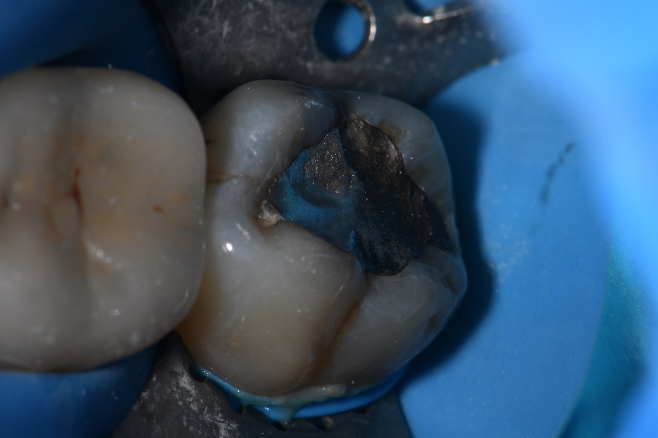 Vertical Hairline Fractures on an amalgam filled wisdom tooth