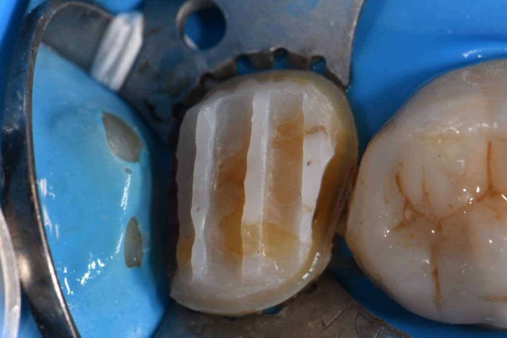 Flexural modulus recovery using bonded indirect ceramics