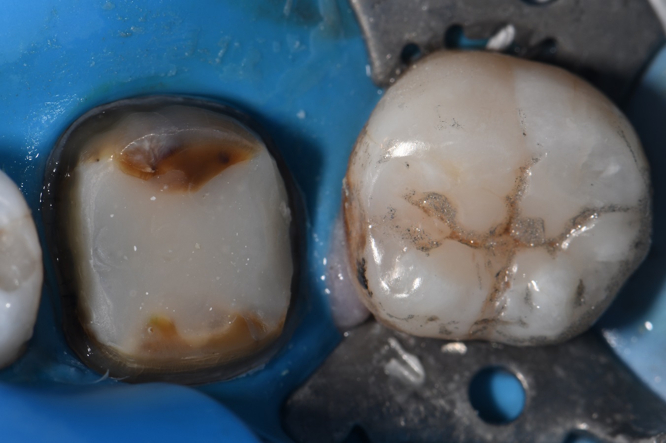Reconstructing a Broken Down Molar