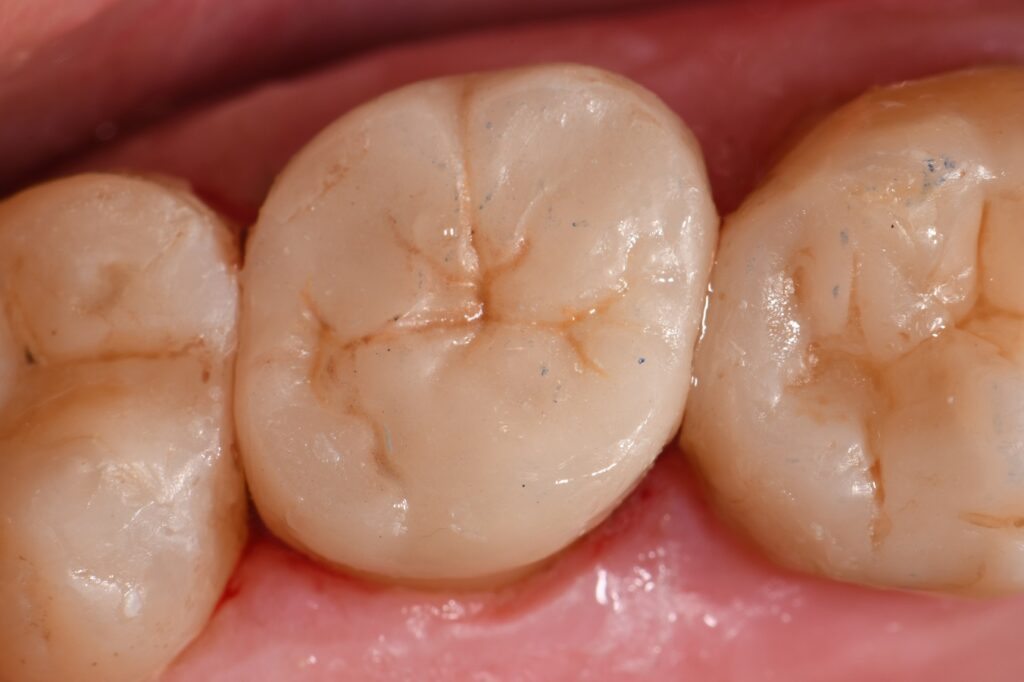 Flexural modulus recovery using bonded indirect ceramics