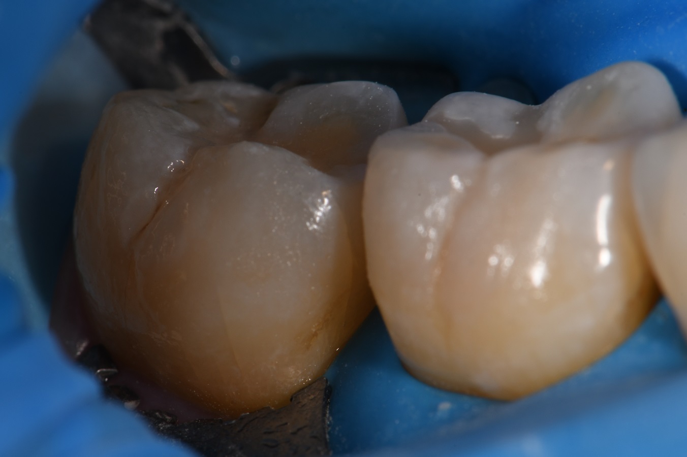Buccal groove restoration using Clearfil Majesty ES2 Universal