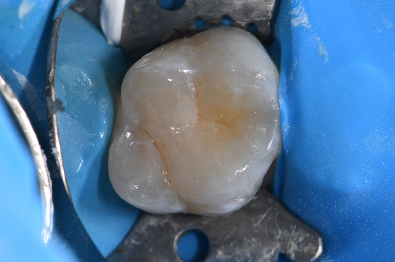 Fissure Sealant Treatment Plan Caries