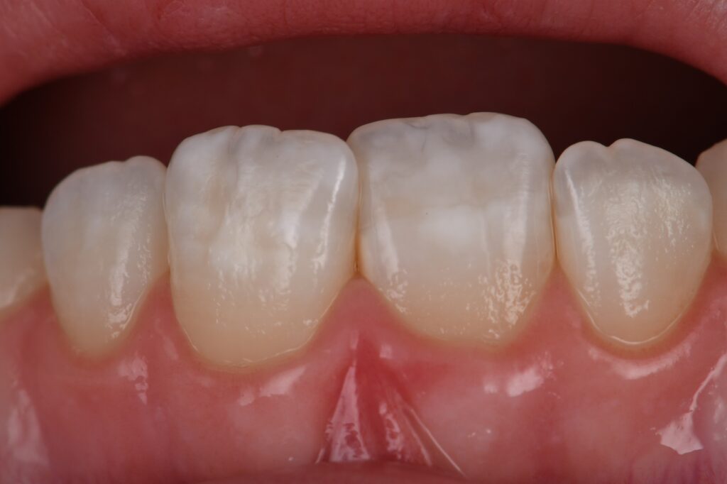 Resin Infiltration Removes White Spots on Teeth
