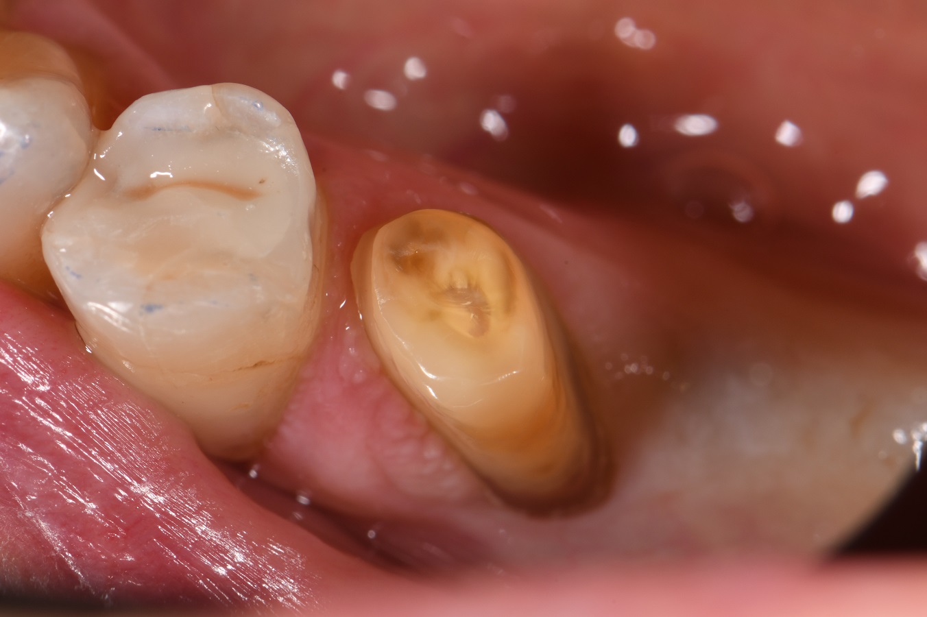 Full crown support for a broken down tooth