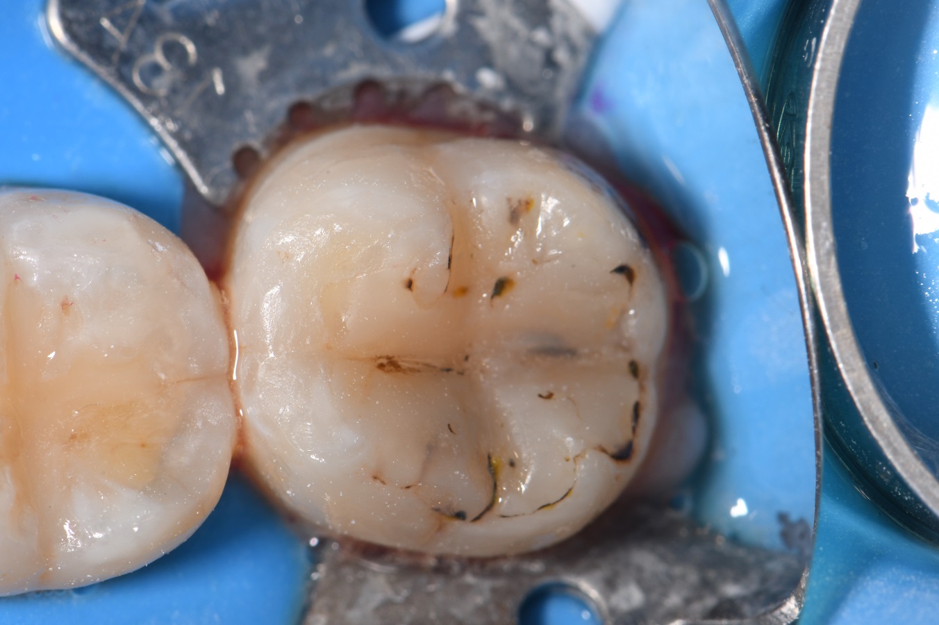 Replacing an old leaking composite filling