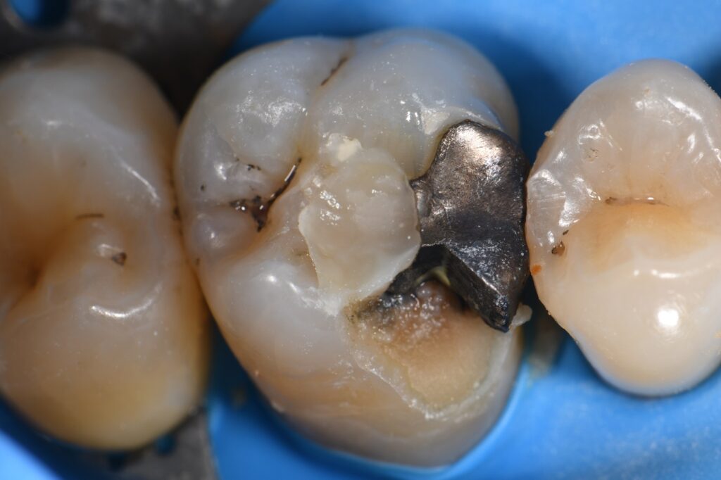 Deep Cracks from Amalgam Fillings