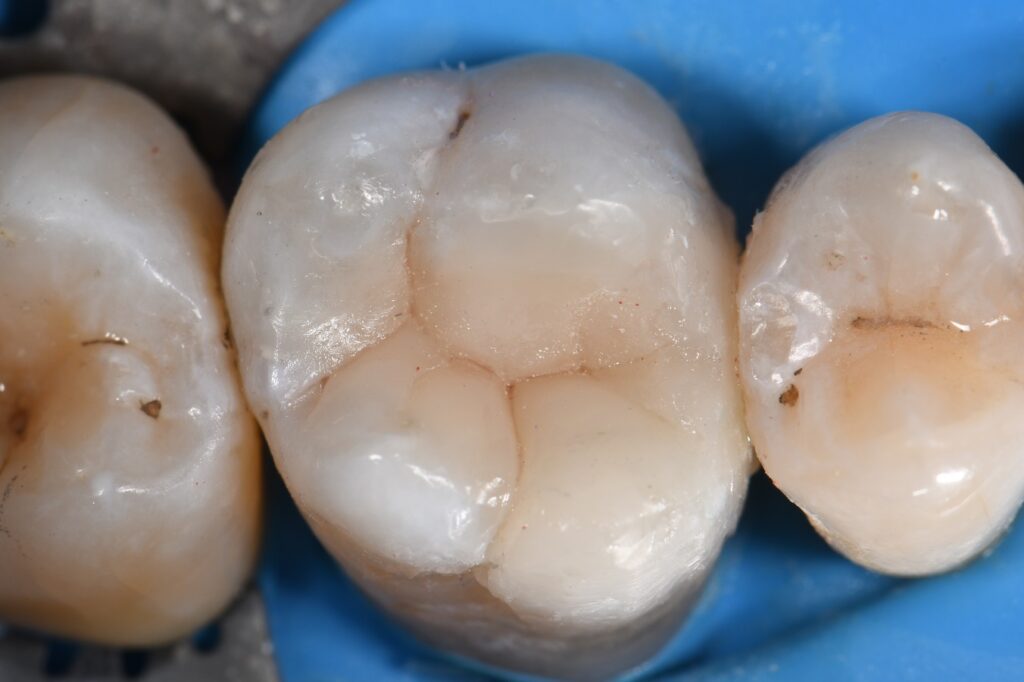 Deep Cracks from Amalgam Fillings