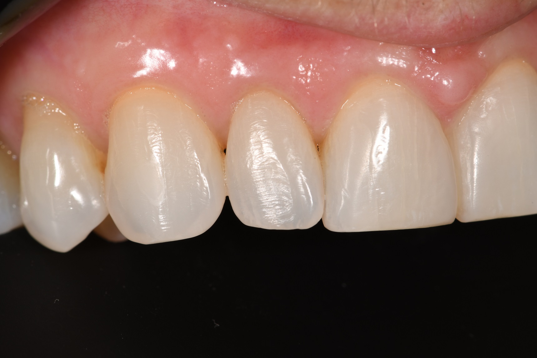 Suresmile Orthodontics | Align Bleach Bond | Voco Amaris