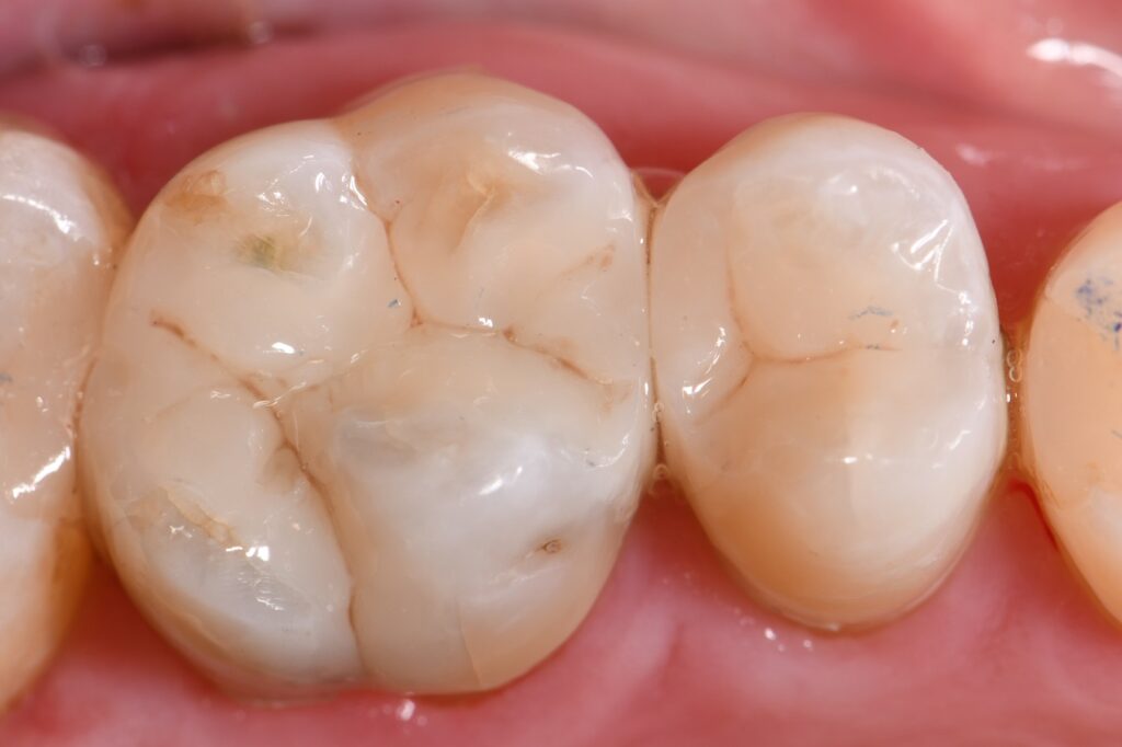 Amalgam restorations replaced with invisible composite