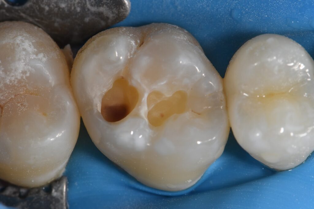 Molar Hypomineralization exhibiting caries