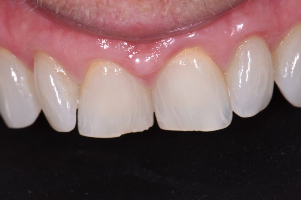 Suresmile Orthodontics Align Bleach Bond Voco Amaris
