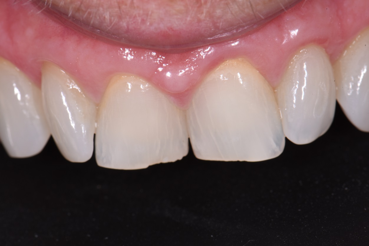 Suresmile Orthodontics | Align Bleach Bond | Voco Amaris