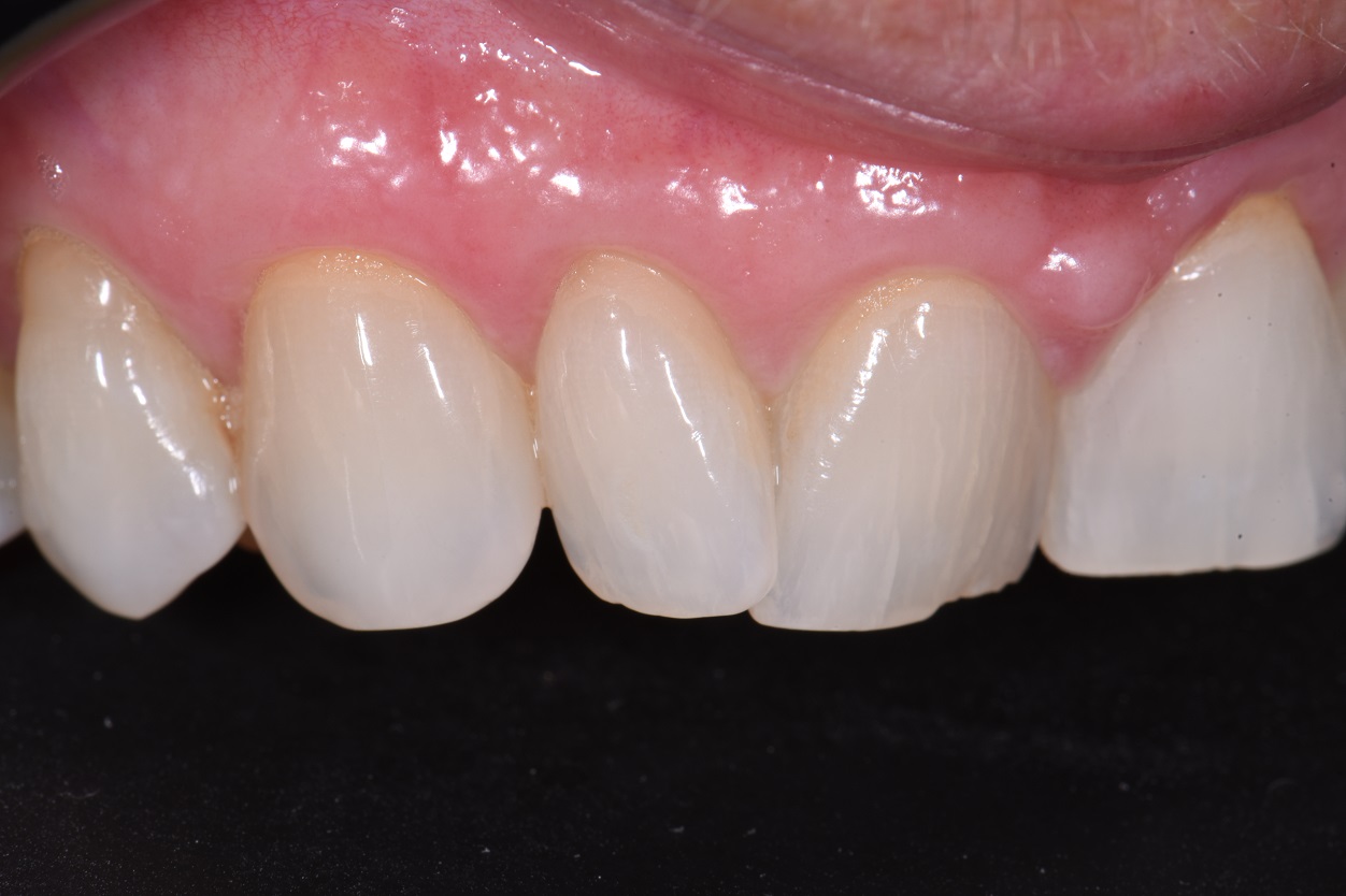 Suresmile Orthodontics | Align Bleach Bond | Voco Amaris