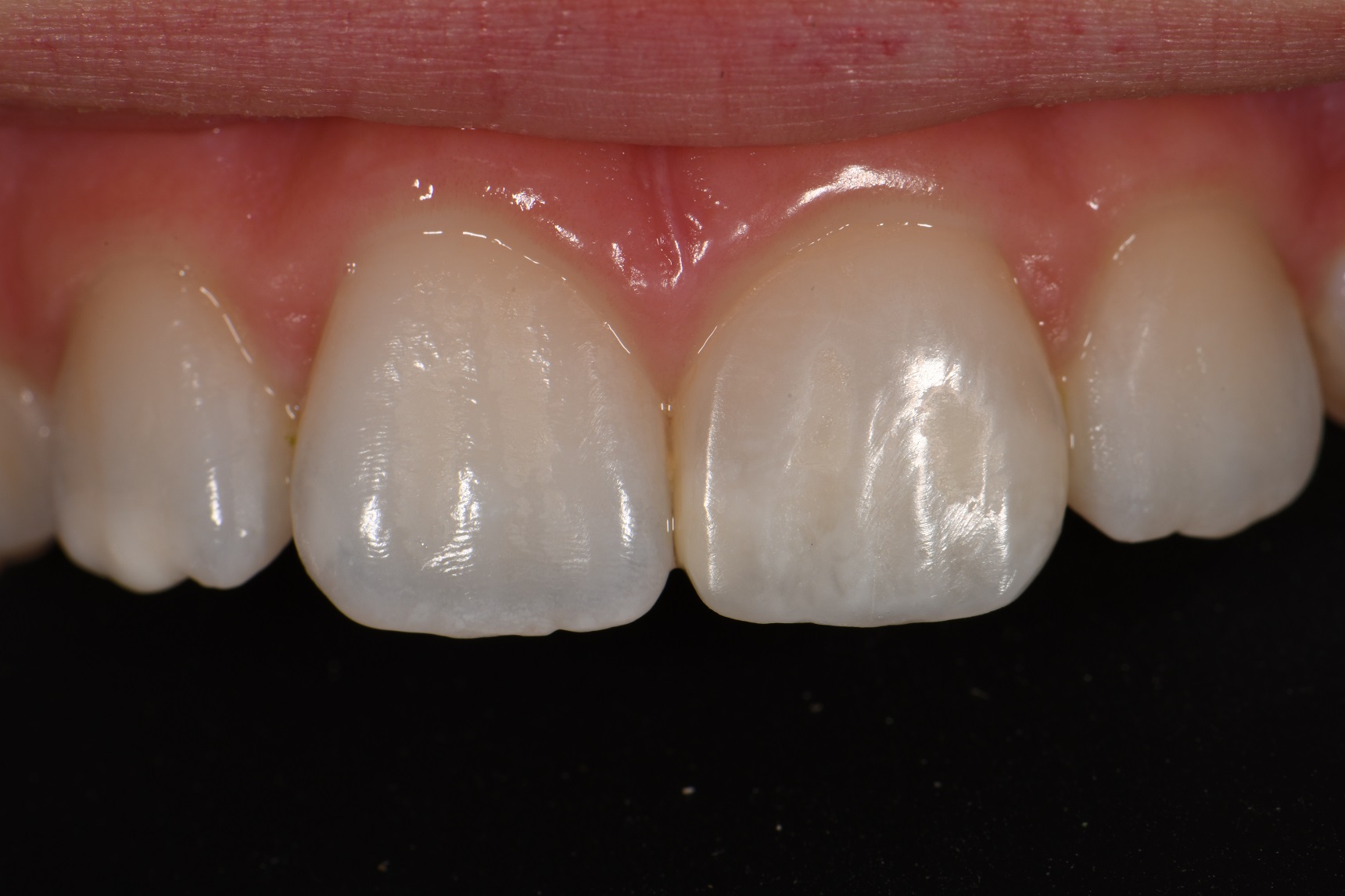Layered Composite Veneer in the Esthetic Zone