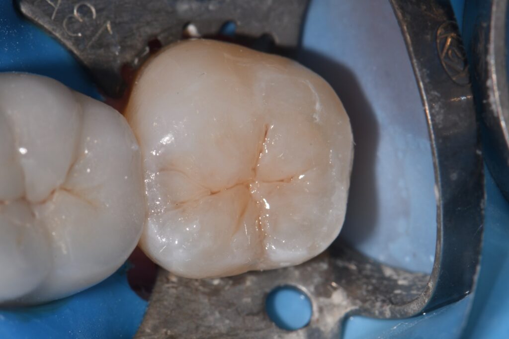 Fissurotomy driven caries removal
