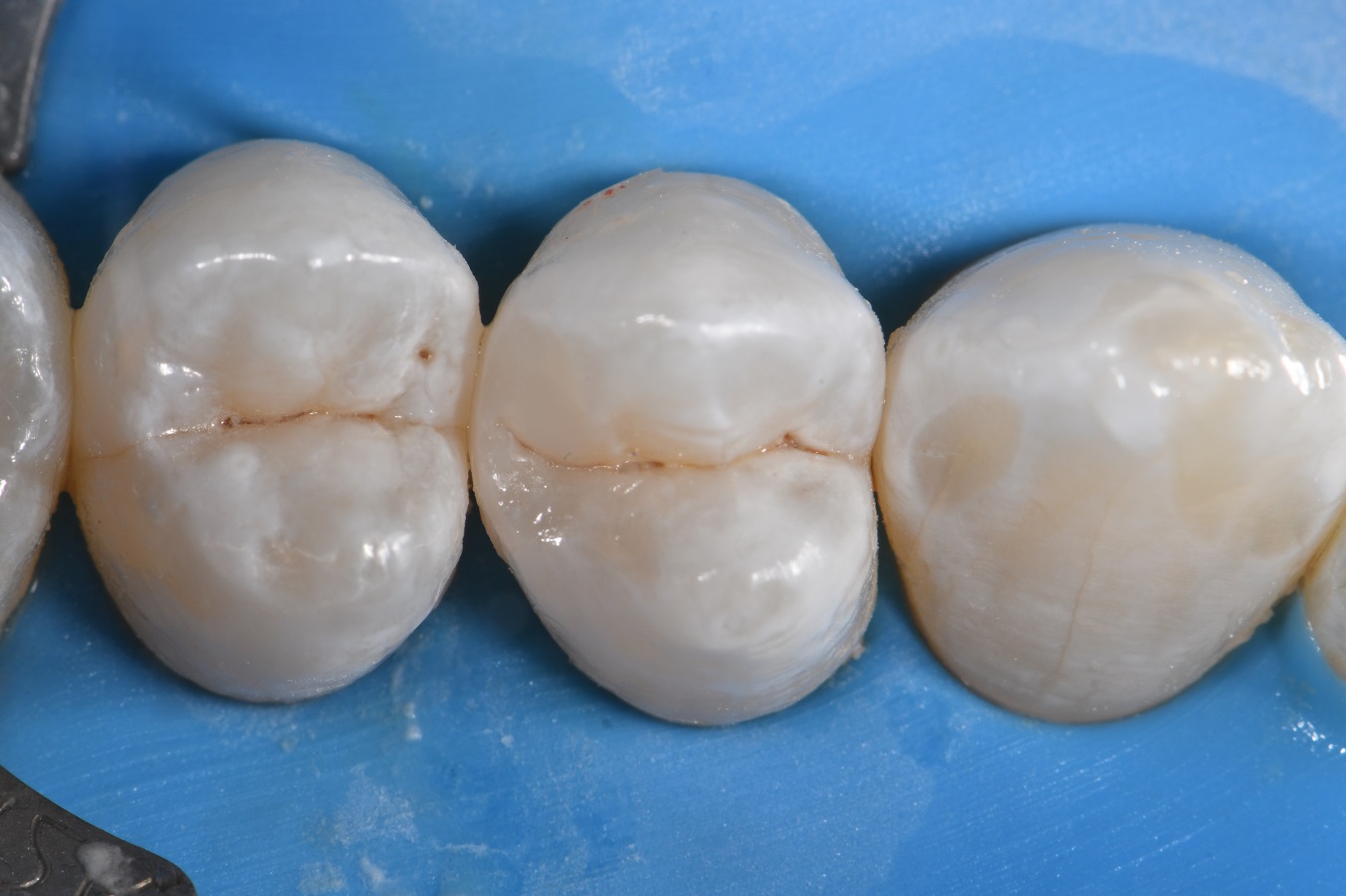 Slot composite restoration using a