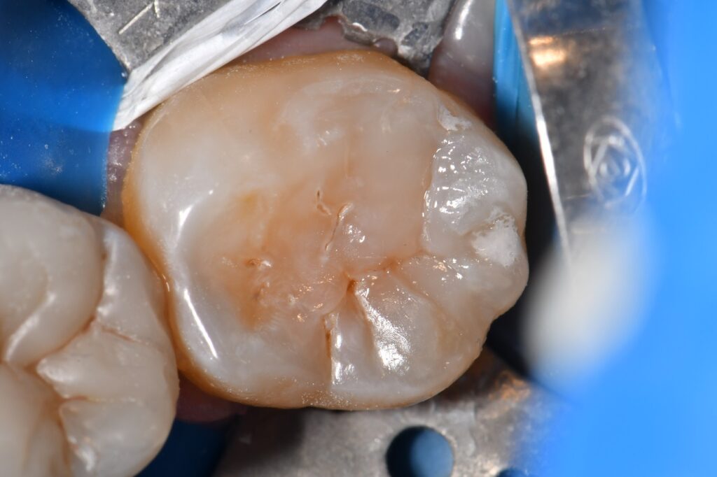 Sectional Caries Removed