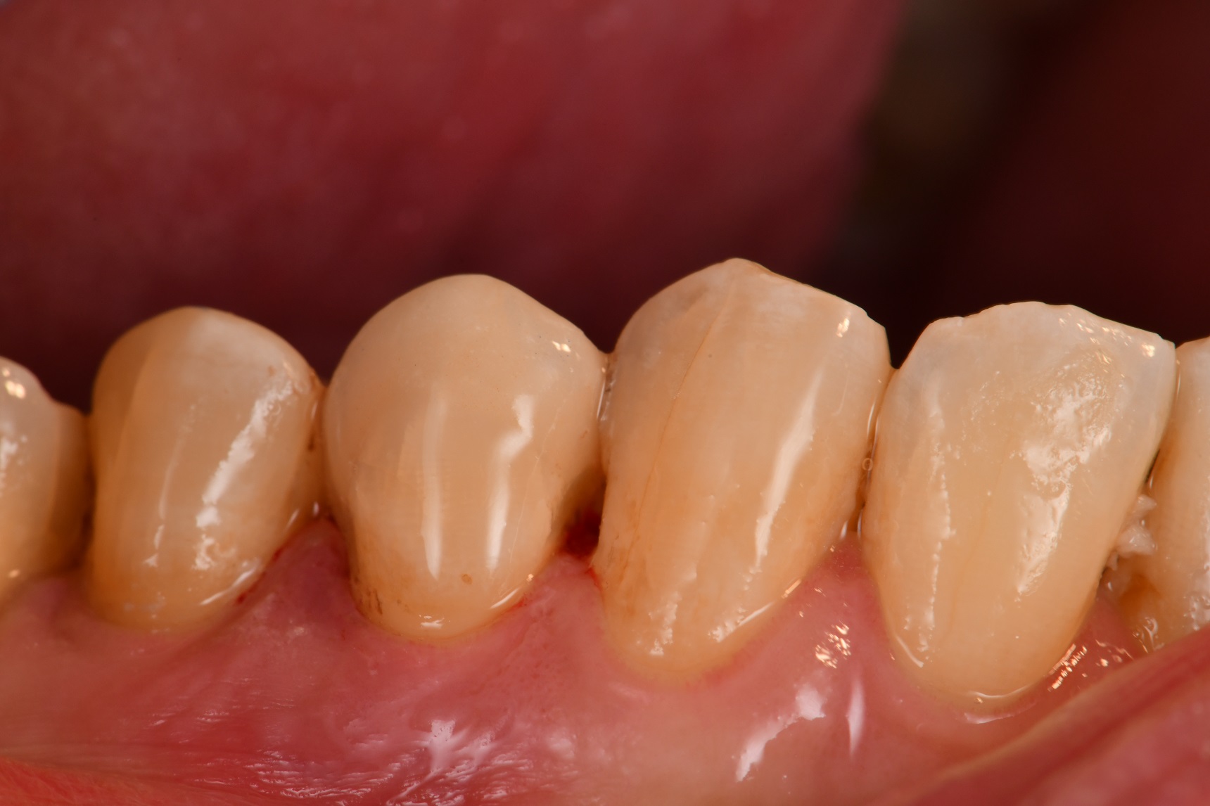 Porcelain Overlays that Blend into tooth structure