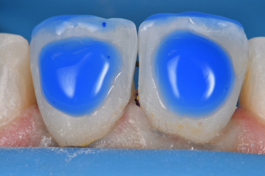 Voco Amaris Composite Veneers